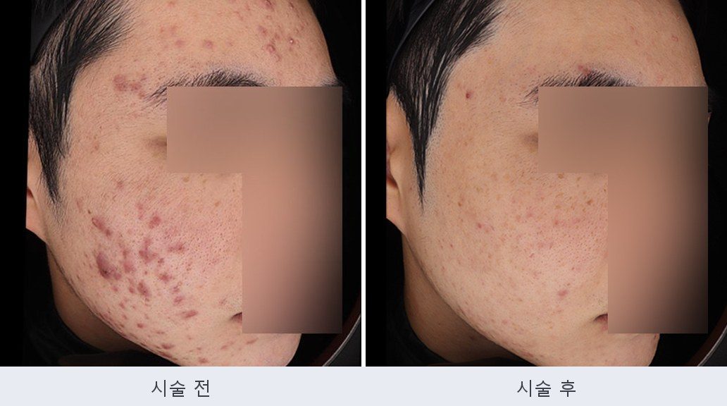 여드름 붉은자국