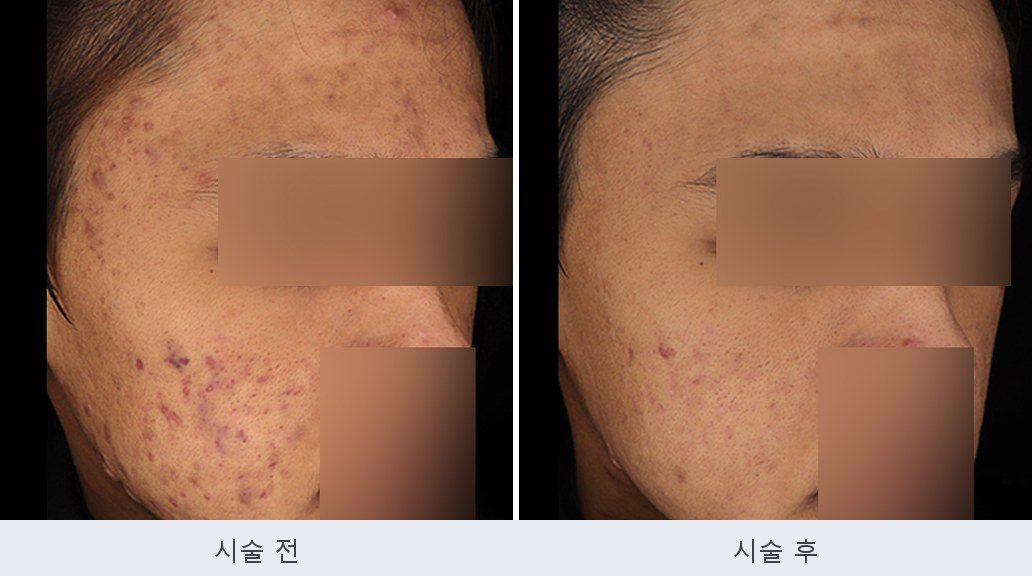 여드름 붉은자국